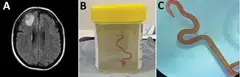 The Ophidascaris robertsi roundworm was discovered last year in a 64-year-old undergoing surgery in the Australian capital, following complaints of abdominal pain, forgetfulness and depression.