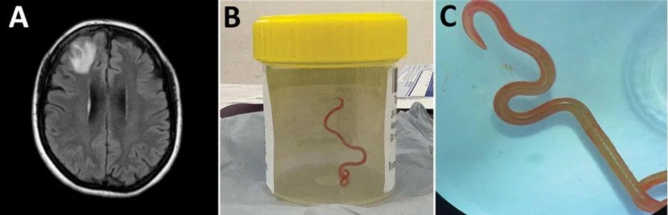 The Ophidascaris robertsi roundworm was discovered last year in a 64-year-old undergoing surgery in the Australian capital, following complaints of abdominal pain, forgetfulness and depression.