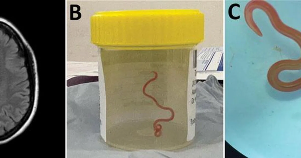 Australian scientists make world-first discovery of parasitic worm in ...