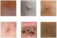 Pictures showing examples of rashes and lesions caused by the monkeypox virus are seen in this undated handout image obtained by Reuters on July 1, 2022. 