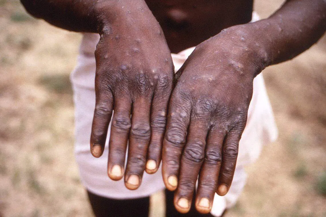 This file photo taken on January 07, 2011  shows the dorsal surfaces of a monkeypox case in a patient who was displaying the appearance of the characteristic rash during its recuperative stage. 
