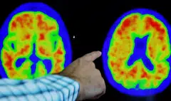 Evidence of Alzheimer’s disease on PET scans. Lilly’s drug, donanemab, like Eisai and Biogen’s recently approved Leqembi, is an intravenous antibody designed to remove deposits of a protein called beta amyloid from the brains of Alzheimer’s patients.
