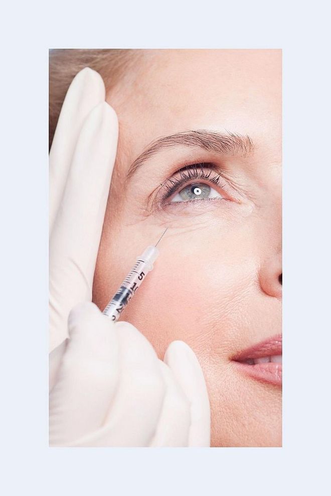 "Filler under the eyes camouflages dark circles and under eye hollows that can make you appear tired. Restylane gives immediate, painless results that can last up to a year. You’ll leave the same day looking like you got 10 hours of sleep." —Dr. Paul Jarrod Frank, celebrity dermatologist and founder of PFRANKMD. Photo: Getty